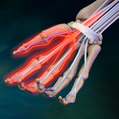 Carpal_Tunnel_Syndrome